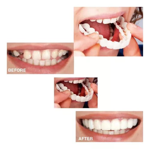 (Paga 1 y lleva 2) Carillas dentales ajustables