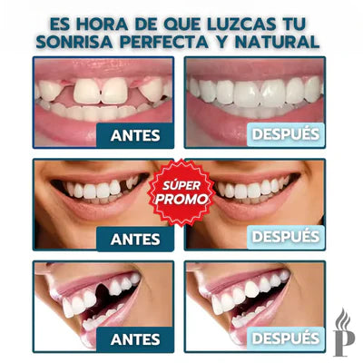 (Paga 1 y lleva 2) Carillas dentales ajustables
